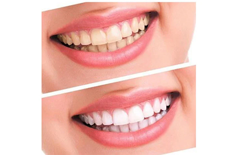 Di� Beyazlatmada Do�ru Bilinen Yanl��lar!